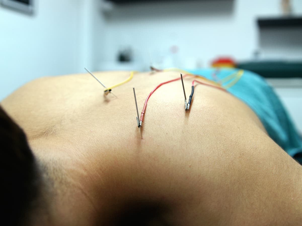 Neuromodulación Percutánea Ecoguiada (NMP)